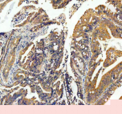 Immunohistochemical staining of BCAP29 using anti-BCAP29 antibody. BCAP29 was detected in a paraffin-embedded section of human colorectal adenocarcinoma tissue. Heat mediated antigen retrieval was performed in EDTA buffer (pH 8.0, epitope retrieval solution). The tissue section was blocked with 10% goat serum. The tissue section was then incubated with 2 ug/ml rabbit anti-BCAP29 antibody overnight at 4oC. Peroxidase Conjugated Goat Anti-rabbit IgG was used as secondary antibody and incubated for 30 minutes at 37oC. The tissue section was developed using an HRP secondary and DAB substrate.