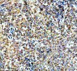 Immunohistochemical staining of SPATA6 using anti-SPATA6 antibody. SPATA6 was detected in a paraffin-embedded section of human testis cancer tissue. Heat mediated antigen retrieval was performed in EDTA buffer (pH 8.0, epitope retrieval solution). The tissue section was blocked with 10% goat serum. The tissue section was then incubated with 2 ug/ml rabbit anti-SPATA6 antibody overnight at 4oC. Peroxidase Conjugated Goat Anti-rabbit IgG was used as secondary antibody and incubated for 30 minutes at 37oC. The tissue section was developed using an HRP secondary and DAB substrate.