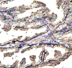 Immunohistochemical staining of GABBR2 using anti-GABBR2 antibody. GABBR2 was detected in a paraffin-embedded section of human prostate cancer tissue. Heat mediated antigen retrieval was performed in EDTA buffer (pH 8.0, epitope retrieval solution). The tissue section was blocked with 10% goat serum. The tissue section was then incubated with 2 ug/ml rabbit anti-GABBR2 antibody overnight at 4oC. Peroxidase Conjugated Goat Anti-rabbit IgG was used as secondary antibody and incubated for 30 minutes at 37oC. The tissue section was developed using an HRP secondary and DAB substrate.