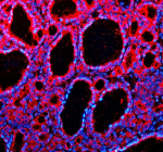 Immunofluorescent staining of TMED1 using anti-TMED1 antibody (red). TMED1 was detected in a paraffin-embedded section of human thyroid cancer tissue. Heat mediated antigen retrieval was performed in EDTA buffer (pH 8.0, epitope retrieval solution). The tissue section was blocked with 10% goat serum. The tissue section was then incubated with 5 ug/ml rabbit anti-TMED1 antibody overnight at 4oC. Cy3 Conjugated Goat Anti-Rabbit IgG was used as secondary antibody at 1:500 dilution and incubated for 30 minutes at 37oC. The section was counterstained with DAPI nuclear stain (blue). Visualize using a fluorescence microscope and filter sets appropriate for the label used.