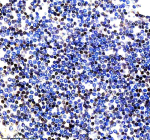 Immunohistochemical staining of PARP15 using anti-PARP15 antibody. PARP15 was detected in a paraffin-embedded section of human spleen tissue. Heat mediated antigen retrieval was performed in EDTA buffer (pH 8.0, epitope retrieval solution). The tissue section was blocked with 10% goat serum. The tissue section was then incubated with 2 ug/ml rabbit anti-PARP15 antibody overnight at 4oC. Peroxidase Conjugated Goat Anti-rabbit IgG was used as secondary antibody and incubated for 30 minutes at 37oC. The tissue section was developed using an HRP secondary and DAB substrate.