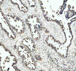 Immunohistochemical staining of OMA1 using anti-OMA1 antibody. OMA1 was detected in a paraffin-embedded section of human ovarian cancer tissue. Heat mediated antigen retrieval was performed in EDTA buffer (pH 8.0, epitope retrieval solution). The tissue section was blocked with 10% goat serum. The tissue section was then incubated with 2 ug/ml rabbit anti-OMA1 antibody overnight at 4oC. Peroxidase Conjugated Goat Anti-rabbit IgG was used as secondary antibody and incubated for 30 minutes at 37oC. The tissue section was developed using an HRP secondary and DAB substrate.