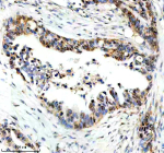 Immunohistochemical staining of PPP1R8 using anti-PPP1R8 antibody. PPP1R8 was detected in a paraffin-embedded section of human pancreas cancer tissue. Heat mediated antigen retrieval was performed in EDTA buffer (pH 8.0, epitope retrieval solution). The tissue section was blocked with 10% goat serum. The tissue section was then incubated with 2 ug/ml rabbit anti-PPP1R8 antibody overnight at 4oC. Peroxidase Conjugated Goat Anti-rabbit IgG was used as secondary antibody and incubated for 30 minutes at 37oC. The tissue section was developed using an HRP secondary and DAB substrate.