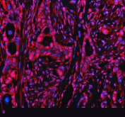 Immunofluorescent staining of PPP1R8 using anti-PPP1R8 antibody (red). PPP1R8 was detected in a paraffin-embedded section of human pancreatic cancer tissue. Heat mediated antigen retrieval was performed in EDTA buffer (pH 8.0, epitope retrieval solution). The tissue section was blocked with 10% goat serum. The tissue section was then incubated with 5 ug/ml rabbit anti-PPP1R8 antibody overnight at 4oC. Cy3 Conjugated Goat Anti-Rabbit IgG was used as secondary antibody at 1:500 dilution and incubated for 30 minutes at 37oC. The section was counterstained with DAPI nuclear stain (blue). Visualize using a fluorescence microscope and filter sets appropriate for the label used.