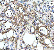 Immunohistochemical staining of PPP1R8 using anti-PPP1R8 antibody. PPP1R8 was detected in a paraffin-embedded section of human pancreas cancer tissue. Heat mediated antigen retrieval was performed in EDTA buffer (pH 8.0, epitope retrieval solution). The tissue section was blocked with 10% goat serum. The tissue section was then incubated with 2 ug/ml rabbit anti-PPP1R8 antibody overnight at 4oC. Peroxidase Conjugated Goat Anti-rabbit IgG was used as secondary antibody and incubated for 30 minutes at 37oC. The tissue section was developed using an HRP secondary and DAB substrate.