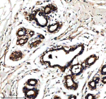Immunohistochemical staining of RALGAPB using anti-RALGAPB antibody. RALGAPB was detected in a paraffin-embedded section of human breast cancer tissue. Heat mediated antigen retrieval was performed in EDTA buffer (pH 8.0, epitope retrieval solution). The tissue section was blocked with 10% goat serum. The tissue section was then incubated with 2 ug/ml rabbit anti-RALGAPB antibody overnight at 4oC. Peroxidase Conjugated Goat Anti-rabbit IgG was used as secondary antibody and incubated for 30 minutes at 37oC. The tissue section was developed using an HRP secondary and DAB substrate.