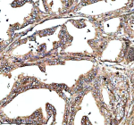 Immunohistochemical staining of MS4A4E using anti-MS4A4E antibody. MS4A4E was detected in a paraffin-embedded section of human prostate cancer tissue. Heat mediated antigen retrieval was performed in EDTA buffer (pH 8.0, epitope retrieval solution). The tissue section was blocked with 10% goat serum. The tissue section was then incubated with 2 ug/ml rabbit anti-MS4A4E antibody overnight at 4oC. Peroxidase Conjugated Goat Anti-rabbit IgG was used as secondary antibody and incubated for 30 minutes at 37oC. The tissue section was developed using an HRP secondary and DAB substrate.