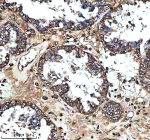 Immunohistochemical staining of MS4A4E using anti-MS4A4E antibody. MS4A4E was detected in a paraffin-embedded section of human ovarian cancer tissue. Heat mediated antigen retrieval was performed in EDTA buffer (pH 8.0, epitope retrieval solution). The tissue section was blocked with 10% goat serum. The tissue section was then incubated with 2 ug/ml rabbit anti-MS4A4E antibody overnight at 4oC. Peroxidase Conjugated Goat Anti-rabbit IgG was used as secondary antibody and incubated for 30 minutes at 37oC. The tissue section was developed using an HRP secondary and DAB substrate.