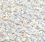 Immunohistochemical staining of IVNS1ABP using anti-IVNS1ABP antibody. IVNS1ABP was detected in a paraffin-embedded section of human glioma tissue. Heat mediated antigen retrieval was performed in EDTA buffer (pH 8.0, epitope retrieval solution). The tissue section was blocked with 10% goat serum. The tissue section was then incubated with 2 ug/ml rabbit anti-IVNS1ABP antibody overnight at 4oC. Peroxidase Conjugated Goat Anti-rabbit IgG was used as secondary antibody and incubated for 30 minutes at 37oC. The tissue section was developed using an HRP secondary and DAB substrate.