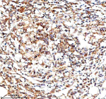 Immunohistochemical staining of IVNS1ABP using anti-IVNS1ABP antibody. IVNS1ABP was detected in a paraffin-embedded section of human ovarian cancer tissue. Heat mediated antigen retrieval was performed in EDTA buffer (pH 8.0, epitope retrieval solution). The tissue section was blocked with 10% goat serum. The tissue section was then incubated with 2 ug/ml rabbit anti-IVNS1ABP antibody overnight at 4oC. Peroxidase Conjugated Goat Anti-rabbit IgG was used as secondary antibody and incubated for 30 minutes at 37oC. The tissue section was developed using an HRP secondary and DAB substrate.