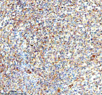 Immunohistochemical staining of IVNS1ABP using anti-IVNS1ABP antibody. IVNS1ABP was detected in a paraffin-embedded section of human lymphoma tissue. Heat mediated antigen retrieval was performed in EDTA buffer (pH 8.0, epitope retrieval solution). The tissue section was blocked with 10% goat serum. The tissue section was then incubated with 2 ug/ml rabbit anti-IVNS1ABP antibody overnight at 4oC. Peroxidase Conjugated Goat Anti-rabbit IgG was used as secondary antibody and incubated for 30 minutes at 37oC. The tissue section was developed using an HRP secondary and DAB substrate.