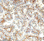 Immunohistochemical staining of IVNS1ABP using anti-IVNS1ABP antibody. IVNS1ABP was detected in a paraffin-embedded section of human thyroid cancer tissue. Heat mediated antigen retrieval was performed in EDTA buffer (pH 8.0, epitope retrieval solution). The tissue section was blocked with 10% goat serum. The tissue section was then incubated with 2 ug/ml rabbit anti-IVNS1ABP antibody overnight at 4oC. Peroxidase Conjugated Goat Anti-rabbit IgG was used as secondary antibody and incubated for 30 minutes at 37oC. The tissue section was developed using an HRP secondary and DAB substrate.