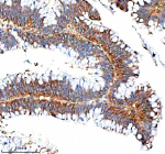 Immunohistochemical staining of IVNS1ABP using anti-IVNS1ABP antibody. IVNS1ABP was detected in a paraffin-embedded section of human colon cancer tissue. Heat mediated antigen retrieval was performed in EDTA buffer (pH 8.0, epitope retrieval solution). The tissue section was blocked with 10% goat serum. The tissue section was then incubated with 2 ug/ml rabbit anti-IVNS1ABP antibody overnight at 4oC. Peroxidase Conjugated Goat Anti-rabbit IgG was used as secondary antibody and incubated for 30 minutes at 37oC. The tissue section was developed using an HRP secondary and DAB substrate.