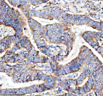 Immunohistochemical staining of MARCKS using anti-MARCKS antibody. MARCKS was detected in a paraffin-embedded section of human stomach cancer tissue. Heat mediated antigen retrieval was performed in EDTA buffer (pH 8.0, epitope retrieval solution). The tissue section was blocked with 10% goat serum. The tissue section was then incubated with 2 ug/ml rabbit anti-MARCKS antibody overnight at 4oC. Peroxidase Conjugated Goat Anti-rabbit IgG was used as secondary antibody and incubated for 30 minutes at 37oC. The tissue section was developed using an HRP secondary and DAB substrate.