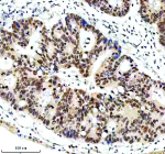 Immunohistochemical staining of ERCC5 using anti-ERCC5 antibody. ERCC5 was detected in a paraffin-embedded section of human colon cancer tissue. Heat mediated antigen retrieval was performed in EDTA buffer (pH 8.0, epitope retrieval solution). The tissue section was blocked with 10% goat serum. The tissue section was then incubated with 2 ug/ml rabbit anti-ERCC5 antibody overnight at 4oC. Peroxidase Conjugated Goat Anti-rabbit IgG was used as secondary antibody and incubated for 30 minutes at 37oC. The tissue section was developed using an HRP secondary and DAB substrate.