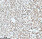 Immunohistochemical staining of GAREM1 using anti-GAREM1 antibody. GAREM1 was detected in a paraffin-embedded section of human liver cancer tissue. Heat mediated antigen retrieval was performed in EDTA buffer (pH 8.0, epitope retrieval solution). The tissue section was blocked with 10% goat serum. The tissue section was then incubated with 2 ug/ml rabbit anti-GAREM1 antibody overnight at 4oC. Peroxidase Conjugated Goat Anti-rabbit IgG was used as secondary antibody and incubated for 30 minutes at 37oC. The tissue section was developed using an HRP secondary and DAB substrate.