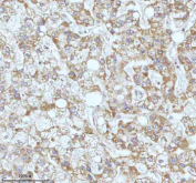 Immunohistochemical staining of GAREM1 using anti-GAREM1 antibody. GAREM1 was detected in a paraffin-embedded section of human liver cancer tissue. Heat mediated antigen retrieval was performed in EDTA buffer (pH 8.0, epitope retrieval solution). The tissue section was blocked with 10% goat serum. The tissue section was then incubated with 2 ug/ml rabbit anti-GAREM1 antibody overnight at 4oC. Peroxidase Conjugated Goat Anti-rabbit IgG was used as secondary antibody and incubated for 30 minutes at 37oC. The tissue section was developed using an HRP secondary and DAB substrate.