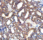 Immunohistochemical staining of PARP16 using anti-PARP16 antibody. PARP16 was detected in a paraffin-embedded section of human thyroid cancer tissue. Heat mediated antigen retrieval was performed in EDTA buffer (pH 8.0, epitope retrieval solution). The tissue section was blocked with 10% goat serum. The tissue section was then incubated with 2 ug/ml rabbit anti-PARP16 antibody overnight at 4oC. Peroxidase Conjugated Goat Anti-rabbit IgG was used as secondary antibody and incubated for 30 minutes at 37oC. The tissue section was developed using an HRP secondary and DAB substrate.