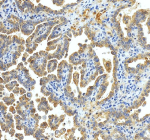 Immunohistochemical staining of xCT/SLC7A11 using anti-SLC7A11 antibody. xCT/SLC7A11 was detected in a paraffin-embedded section of human ovraian cancer tissue. Heat mediated antigen retrieval was performed in EDTA buffer (pH 8.0, epitope retrieval solution). The tissue section was blocked with 10% goat serum. The tissue section was then incubated with 2 ug/ml rabbit anti-SLC7A11 antibody overnight at 4oC. Peroxidase Conjugated Goat Anti-rabbit IgG was used as secondary antibody and incubated for 30 minutes at 37oC. The tissue section was developed using an HRP secondary and DAB substrate.