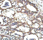 Immunohistochemical staining of PAN3 using anti-PAN3 antibody. PAN3 was detected in a paraffin-embedded section of human pancreas cancer tissue. Heat mediated antigen retrieval was performed in EDTA buffer (pH 8.0, epitope retrieval solution). The tissue section was blocked with 10% goat serum. The tissue section was then incubated with 2 ug/ml rabbit anti-PAN3 antibody overnight at 4oC. Peroxidase Conjugated Goat Anti-rabbit IgG was used as secondary antibody and incubated for 30 minutes at 37oC. The tissue section was developed using an HRP secondary and DAB substrate.