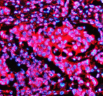 Immunofluorescent staining of STX5 using anti-STX5 antibody (red). STX5 was detected in a paraffin-embedded section of human breast cancer tissue. Heat mediated antigen retrieval was performed in EDTA buffer (pH 8.0, epitope retrieval solution). The tissue section was blocked with 10% goat serum. The tissue section was then incubated with 5 ug/ml rabbit anti-STX5 antibody overnight at 4oC. Cy3 Conjugated Goat Anti-Rabbit IgG was used as secondary antibody at 1:500 dilution and incubated for 30 minutes at 37oC. The section was counterstained with DAPI nuclear stain (blue). Visualize using a fluorescence microscope and filter sets appropriate for the label used.
