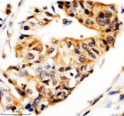Immunohistochemical staining of STX5 using anti-STX5 antibody. STX5 was detected in a paraffin-embedded section of human breast cancer tissue. Heat mediated antigen retrieval was performed in EDTA buffer (pH 8.0, epitope retrieval solution). The tissue section was blocked with 10% goat serum. The tissue section was then incubated with 2 ug/ml rabbit anti-STX5 antibody overnight at 4oC. Peroxidase Conjugated Goat Anti-rabbit IgG was used as secondary antibody and incubated for 30 minutes at 37oC. The tissue section was developed using an HRP secondary and DAB substrate.