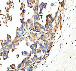 Immunohistochemical staining of SPON1 using anti-SPON1 antibody. SPON1 was detected in a paraffin-embedded section of human ovarian cancer tissue. Heat mediated antigen retrieval was performed in EDTA buffer (pH 8.0, epitope retrieval solution). The tissue section was blocked with 10% goat serum. The tissue section was then incubated with 2 ug/ml rabbit anti-SPON1 antibody overnight at 4oC. Peroxidase Conjugated Goat Anti-rabbit IgG was used as secondary antibody and incubated for 30 minutes at 37oC. The tissue section was developed using an HRP secondary and DAB substrate.