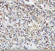 Immunohistochemical staining of STRIP2 using anti-STRIP2 antibody. STRIP2 was detected in a paraffin-embedded section of human breast cancer tissue. Heat mediated antigen retrieval was performed in EDTA buffer (pH 8.0, epitope retrieval solution). The tissue section was blocked with 10% goat serum. The tissue section was then incubated with 2 ug/ml rabbit anti-STRIP2 antibody overnight at 4oC. Peroxidase Conjugated Goat Anti-rabbit IgG was used as secondary antibody and incubated for 30 minutes at 37oC. The tissue section was developed using an HRP secondary and DAB substrate.