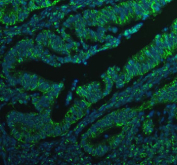 Immunofluorescent staining of BCAP31 using anti-BCAP31 antibody (green). BCAP31 was detected in a paraffin-embedded section of human colon cancer tissue. Heat mediated antigen retrieval was performed in EDTA buffer (pH 8.0, epitope retrieval solution). The tissue section was blocked with 10% goat serum. The tissue section was then incubated with 5 ug/ml rabbit anti-BCAP31 antibody overnight at 4oC. DyLight 488 Conjugated Goat Anti-Rabbit IgG was used as secondary antibody at 1:500 dilution and incubated for 30 minutes at 37oC. The section was counterstained with DAPI nuclear stain (blue). Visualize using a fluorescence microscope and filter sets appropriate for the label used.