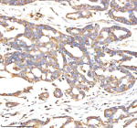 Immunohistochemical staining of BCAP31 using anti-BCAP31 antibody. BCAP31 was detected in a paraffin-embedded section of human ovarian cancer tissue. Heat mediated antigen retrieval was performed in EDTA buffer (pH 8.0, epitope retrieval solution). The tissue section was blocked with 10% goat serum. The tissue section was then incubated with 2 ug/ml rabbit anti-BCAP31 antibody overnight at 4oC. Peroxidase Conjugated Goat Anti-rabbit IgG was used as secondary antibody and incubated for 30 minutes at 37oC. The tissue section was developed using an HRP secondary and DAB substrate.