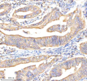 Immunohistochemical staining of BCAP31 using anti-BCAP31 antibody. BCAP31 was detected in a paraffin-embedded section of human colon cancer tissue. Heat mediated antigen retrieval was performed in EDTA buffer (pH 8.0, epitope retrieval solution). The tissue section was blocked with 10% goat serum. The tissue section was then incubated with 2 ug/ml rabbit anti-BCAP31 antibody overnight at 4oC. Peroxidase Conjugated Goat Anti-rabbit IgG was used as secondary antibody and incubated for 30 minutes at 37oC. The tissue section was developed using an HRP secondary and DAB substrate.