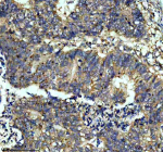 Immunohistochemical staining of ITGB7 using anti-ITGB7 antibody. ITGB7 was detected in a paraffin-embedded section of human colon cancer tissue. Heat mediated antigen retrieval was performed in EDTA buffer (pH 8.0, epitope retrieval solution). The tissue section was blocked with 10% goat serum. The tissue section was then incubated with 1:50 rabbit anti-ITGB7 antibody overnight at 4oC. Peroxidase Conjugated Goat Anti-rabbit IgG was used as secondary antibody and incubated for 30 minutes at 37oC. The tissue section was developed using an HRP secondary and DAB substrate.