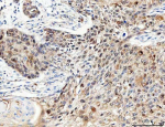 Immunohistochemical staining of RB1 using anti-RB1 antibody. RB1 was detected in a paraffin-embedded section of human esophageal squamous carcinoma tissue. Heat mediated antigen retrieval was performed in EDTA buffer (pH 8.0, epitope retrieval solution). The tissue section was blocked with 10% goat serum. The tissue section was then incubated with 1:100 rabbit anti-RB1 antibody overnight at 4oC. Peroxidase Conjugated Goat Anti-rabbit IgG was used as secondary antibody and incubated for 30 minutes at 37oC. The tissue section was developed using an HRP secondary and DAB substrate.
