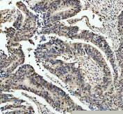 Immunohistochemical staining of RB1 using anti-RB1 antibody. RB1 was detected in a paraffin-embedded section of human colon cancer tissue. Heat mediated antigen retrieval was performed in EDTA buffer (pH 8.0, epitope retrieval solution). The tissue section was blocked with 10% goat serum. The tissue section was then incubated with 2 ug/ml rabbit anti-RB1 antibody overnight at 4oC. Peroxidase Conjugated Goat Anti-rabbit IgG was used as secondary antibody and incubated for 30 minutes at 37oC. The tissue section was developed using an HRP secondary and DAB substrate.