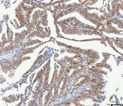 Immunohistochemical staining of RB1 using anti-RB1 antibody. RB1 was detected in a paraffin-embedded section of human colorectal adenocarcinoma tissue. Heat mediated antigen retrieval was performed in EDTA buffer (pH 8.0, epitope retrieval solution). The tissue section was blocked with 10% goat serum. The tissue section was then incubated with 1:100 rabbit anti-RB1 antibody overnight at 4oC. Peroxidase Conjugated Goat Anti-rabbit IgG was used as secondary antibody and incubated for 30 minutes at 37oC. The tissue section was developed using an HRP secondary and DAB substrate.