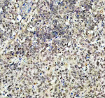 Immunohistochemical staining of RB1 using anti-RB1 antibody. RB1 was detected in a paraffin-embedded section of human cervical cancer tissue. Heat mediated antigen retrieval was performed in EDTA buffer (pH 8.0, epitope retrieval solution). The tissue section was blocked with 10% goat serum. The tissue section was then incubated with 2 ug/ml rabbit anti-RB1 antibody overnight at 4oC. Peroxidase Conjugated Goat Anti-rabbit IgG was used as secondary antibody and incubated for 30 minutes at 37oC. The tissue section was developed using an HRP secondary and DAB substrate.