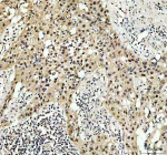 Immunohistochemical staining of RB1 using anti-RB1 antibody. RB1 was detected in a paraffin-embedded section of human bladder cancer tissue. Heat mediated antigen retrieval was performed in EDTA buffer (pH 8.0, epitope retrieval solution). The tissue section was blocked with 10% goat serum. The tissue section was then incubated with 2 ug/ml rabbit anti-RB1 antibody overnight at 4oC. Peroxidase Conjugated Goat Anti-rabbit IgG was used as secondary antibody and incubated for 30 minutes at 37oC. The tissue section was developed using an HRP secondary and DAB substrate.