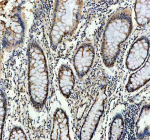 Immunohistochemical staining of RB1 using anti-RB1 antibody. RB1 was detected in a paraffin-embedded section of human colon cancer tissue. Heat mediated antigen retrieval was performed in EDTA buffer (pH 8.0, epitope retrieval solution). The tissue section was blocked with 10% goat serum. The tissue section was then incubated with 2 ug/ml rabbit anti-RB1 antibody overnight at 4oC. Peroxidase Conjugated Goat Anti-rabbit IgG was used as secondary antibody and incubated for 30 minutes at 37oC. The tissue section was developed using an HRP secondary and DAB substrate.