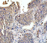 Immunohistochemical staining of RB1 using anti-RB1 antibody. RB1 was detected in a paraffin-embedded section of human liver cancer tissue. Heat mediated antigen retrieval was performed in EDTA buffer (pH 8.0, epitope retrieval solution). The tissue section was blocked with 10% goat serum. The tissue section was then incubated with 2 ug/ml rabbit anti-RB1 antibody overnight at 4oC. Peroxidase Conjugated Goat Anti-rabbit IgG was used as secondary antibody and incubated for 30 minutes at 37oC. The tissue section was developed using an HRP secondary and DAB substrate.
