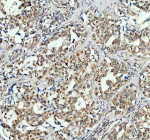 Immunohistochemical staining of RB1 using anti-RB1 antibody. RB1 was detected in a paraffin-embedded section of human lung cancer tissue. Heat mediated antigen retrieval was performed in EDTA buffer (pH 8.0, epitope retrieval solution). The tissue section was blocked with 10% goat serum. The tissue section was then incubated with 2 ug/ml rabbit anti-RB1 antibody overnight at 4oC. Peroxidase Conjugated Goat Anti-rabbit IgG was used as secondary antibody and incubated for 30 minutes at 37oC. The tissue section was developed using an HRP secondary and DAB substrate.