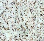 Immunohistochemical staining of RB1 using anti-RB1 antibody. RB1 was detected in a paraffin-embedded section of human breast cancer tissue. Heat mediated antigen retrieval was performed in EDTA buffer (pH 8.0, epitope retrieval solution). The tissue section was blocked with 10% goat serum. The tissue section was then incubated with 2 ug/ml rabbit anti-RB1 antibody overnight at 4oC. Peroxidase Conjugated Goat Anti-rabbit IgG was used as secondary antibody and incubated for 30 minutes at 37oC. The tissue section was developed using an HRP secondary and DAB substrate.