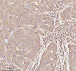 Immunohistochemical staining of MICALL1 using anti-MICALL1 antibody. MICALL1 was detected in a paraffin-embedded section of human breast cancer tissue. Heat mediated antigen retrieval was performed in EDTA buffer (pH 8.0, epitope retrieval solution). The tissue section was blocked with 10% goat serum. The tissue section was then incubated with 2 ug/ml rabbit anti-MICALL1 antibody overnight at 4oC. Peroxidase Conjugated Goat Anti-rabbit IgG was used as secondary antibody and incubated for 30 minutes at 37oC. The tissue section was developed using an HRP secondary and DAB substrate.