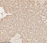 Immunohistochemical staining of MICALL1 using anti-MICALL1 antibody. MICALL1 was detected in a paraffin-embedded section of human liver cancer tissue. Heat mediated antigen retrieval was performed in EDTA buffer (pH 8.0, epitope retrieval solution). The tissue section was blocked with 10% goat serum. The tissue section was then incubated with 2 ug/ml rabbit anti-MICALL1 antibody overnight at 4oC. Peroxidase Conjugated Goat Anti-rabbit IgG was used as secondary antibody and incubated for 30 minutes at 37oC. The tissue section was developed using an HRP secondary and DAB substrate.