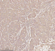 Immunohistochemical staining of MICALL1 using anti-MICALL1 antibody. MICALL1 was detected in a paraffin-embedded section of human breast cancer tissue. Heat mediated antigen retrieval was performed in EDTA buffer (pH 8.0, epitope retrieval solution). The tissue section was blocked with 10% goat serum. The tissue section was then incubated with 2 ug/ml rabbit anti-MICALL1 antibody overnight at 4oC. Peroxidase Conjugated Goat Anti-rabbit IgG was used as secondary antibody and incubated for 30 minutes at 37oC. The tissue section was developed using an HRP secondary and DAB substrate.