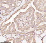 Immunohistochemical staining of MICALL1 using anti-MICALL1 antibody. MICALL1 was detected in a paraffin-embedded section of human thyroid papillary carcinoma tissue. Heat mediated antigen retrieval was performed in EDTA buffer (pH 8.0, epitope retrieval solution). The tissue section was blocked with 10% goat serum. The tissue section was then incubated with 2 ug/ml rabbit anti-MICALL1 antibody overnight at 4oC. Peroxidase Conjugated Goat Anti-rabbit IgG was used as secondary antibody and incubated for 30 minutes at 37oC. The tissue section was developed using an HRP secondary and DAB substrate.
