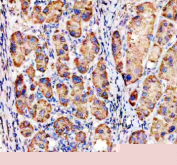 Immunohistochemical staining of MFSD2A using anti-MFSD2A antibody. MFSD2A was detected in a paraffin-embedded section of human liver cancer tissue. Heat mediated antigen retrieval was performed in EDTA buffer (pH 8.0, epitope retrieval solution). The tissue section was blocked with 10% goat serum. The tissue section was then incubated with 2 ug/ml rabbit anti-MFSD2A antibody overnight at 4oC. Peroxidase Conjugated Goat Anti-rabbit IgG was used as secondary antibody and incubated for 30 minutes at 37oC. The tissue section was developed using an HRP secondary and DAB substrate.