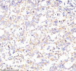 Immunohistochemical staining of POC1A using anti-POC1A antibody. POC1A was detected in a paraffin-embedded section of human stomach cancer tissue. Heat mediated antigen retrieval was performed in EDTA buffer (pH 8.0, epitope retrieval solution). The tissue section was blocked with 10% goat serum. The tissue section was then incubated with 2 ug/ml rabbit anti-POC1A antibody overnight at 4oC. Peroxidase Conjugated Goat Anti-rabbit IgG was used as secondary antibody and incubated for 30 minutes at 37oC. The tissue section was developed using an HRP secondary and DAB substrate.