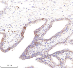 Immunohistochemical staining of POC1A using anti-POC1A antibody. POC1A was detected in a paraffin-embedded section of human prostate cancer tissue. Heat mediated antigen retrieval was performed in EDTA buffer (pH 8.0, epitope retrieval solution). The tissue section was blocked with 10% goat serum. The tissue section was then incubated with 2 ug/ml rabbit anti-POC1A antibody overnight at 4oC. Peroxidase Conjugated Goat Anti-rabbit IgG was used as secondary antibody and incubated for 30 minutes at 37oC. The tissue section was developed using an HRP secondary and DAB substrate.