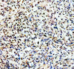Immunohistochemical staining of TERF2IP using anti-TERF2IP antibody. TERF2IP was detected in a paraffin-embedded section of human glioma tissue. Heat mediated antigen retrieval was performed in EDTA buffer (pH 8.0, epitope retrieval solution). The tissue section was blocked with 10% goat serum. The tissue section was then incubated with 2 ug/ml rabbit anti-TERF2IP antibody overnight at 4oC. Peroxidase Conjugated Goat Anti-rabbit IgG was used as secondary antibody and incubated for 30 minutes at 37oC. The tissue section was developed using an HRP secondary and DAB substrate.