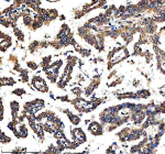 Immunohistochemical staining of RTRAF using anti-RTRAF antibody. RTRAF was detected in a paraffin-embedded section of human lung cancer tissue. Heat mediated antigen retrieval was performed in EDTA buffer (pH 8.0, epitope retrieval solution). The tissue section was blocked with 10% goat serum. The tissue section was then incubated with 2 ug/ml rabbit anti-RTRAF antibody overnight at 4oC. Peroxidase Conjugated Goat Anti-rabbit IgG was used as secondary antibody and incubated for 30 minutes at 37oC. The tissue section was developed using an HRP secondary and DAB substrate.